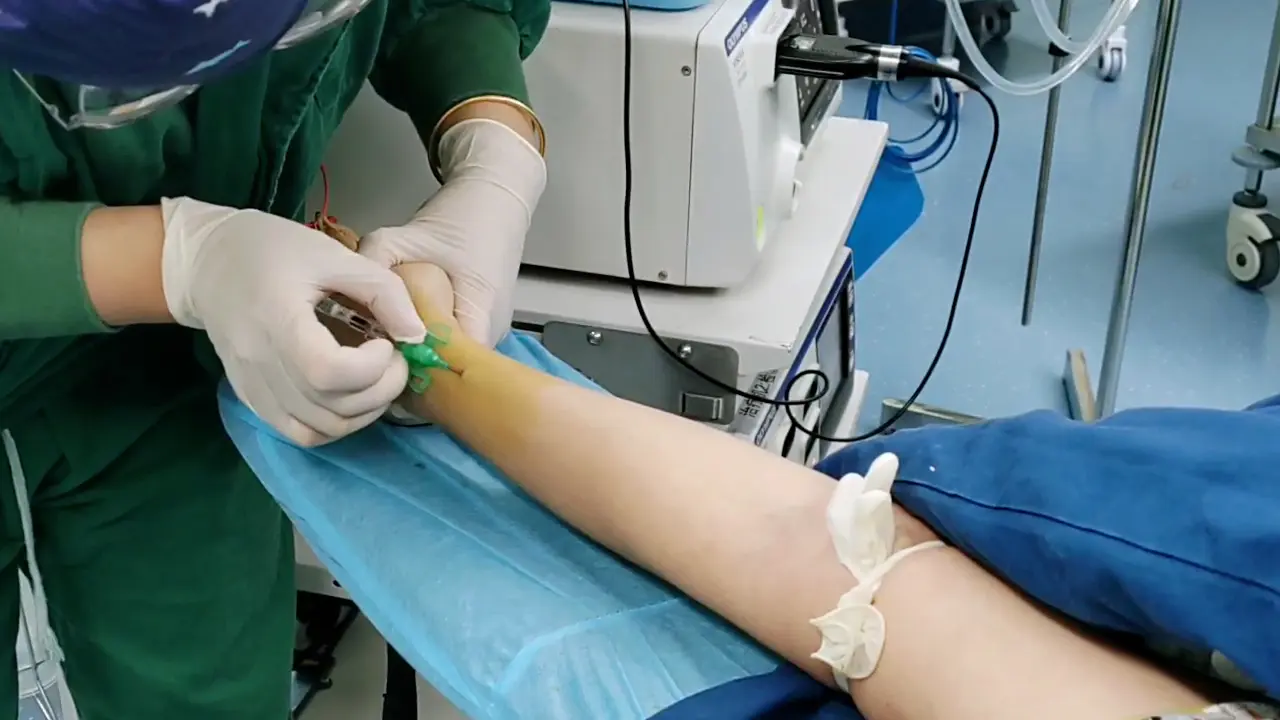 Improved Hysteroscopic Resection of Endometrial Polyps Using 6-Fr Micro-Scissors and Forceps