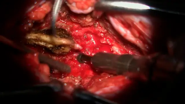 Spinal Hernia Repair and Cauda Equina Repositioning After Lumbar Decompression under Three-Dimensional Microscopy: A Case Report and Literature Review