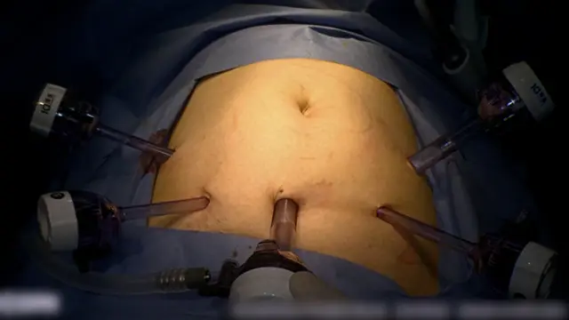 Surgical Trunk Oriented Laparoscopic Right Hemicolectomy (ST-LRH) for Right-Sided Colon Cancer