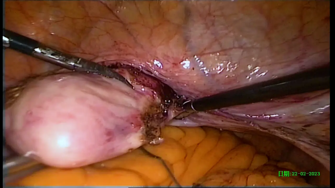 Laparoscopic Non-Mesh Cerclage Pectopexy with Uterine Preservation for Pelvic Organ Prolapse