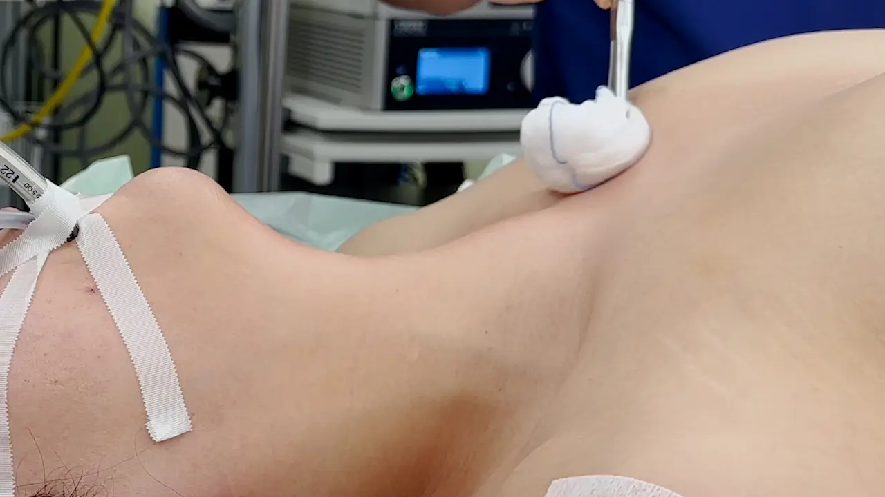 Minimal Invasive Resection of Large Retrosternal Thyroid Goiter