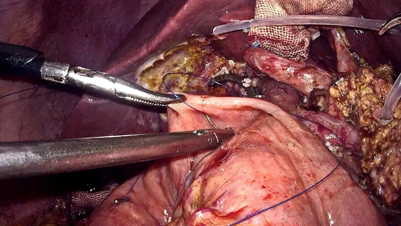 Reverse Needle Continuous Suture of the Pancreatic Duct to Jejunal Mucosal Pancreaticointestinal Anastomosis in Laparoscopic Pancreaticoduodenectomy