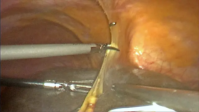 Complete Laparoscopic Radical Resection of Perihilar Cholangiocarcinoma Type IIIb