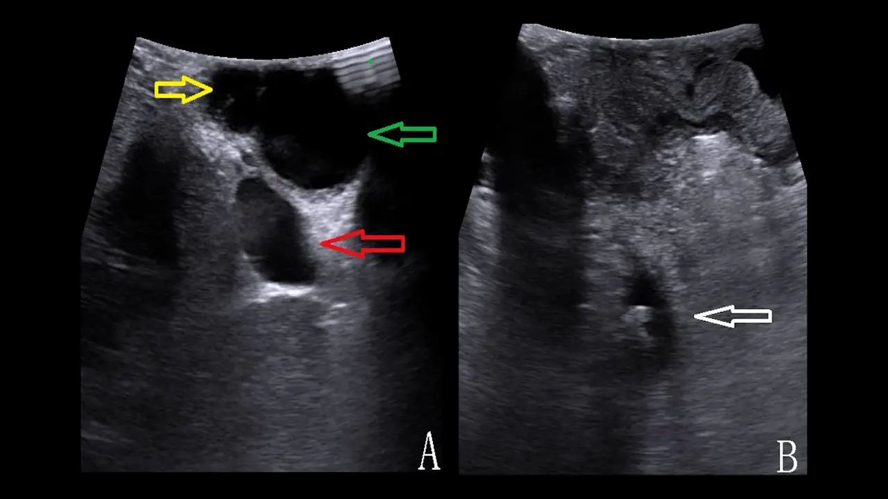Application of Laparoscopic Ultrasonography in Primary Choledochal Suture during Combined Two-lens Surgery
