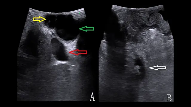 Application of Laparoscopic Ultrasonography in Primary Choledochal Suture during Combined Two-lens Surgery