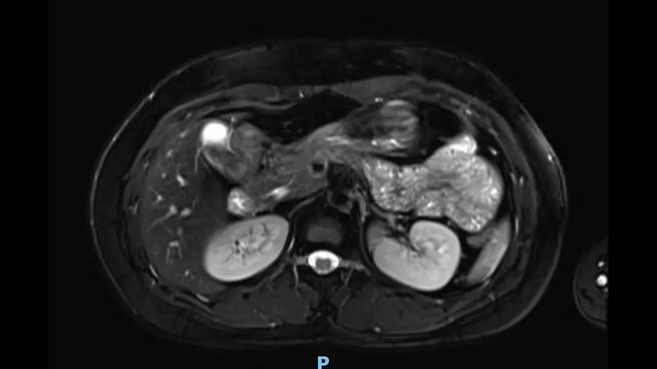 Laparoscopic Choledochal Cyst Excision and Roux-en-Y Choledochojejunostomy in Adults
