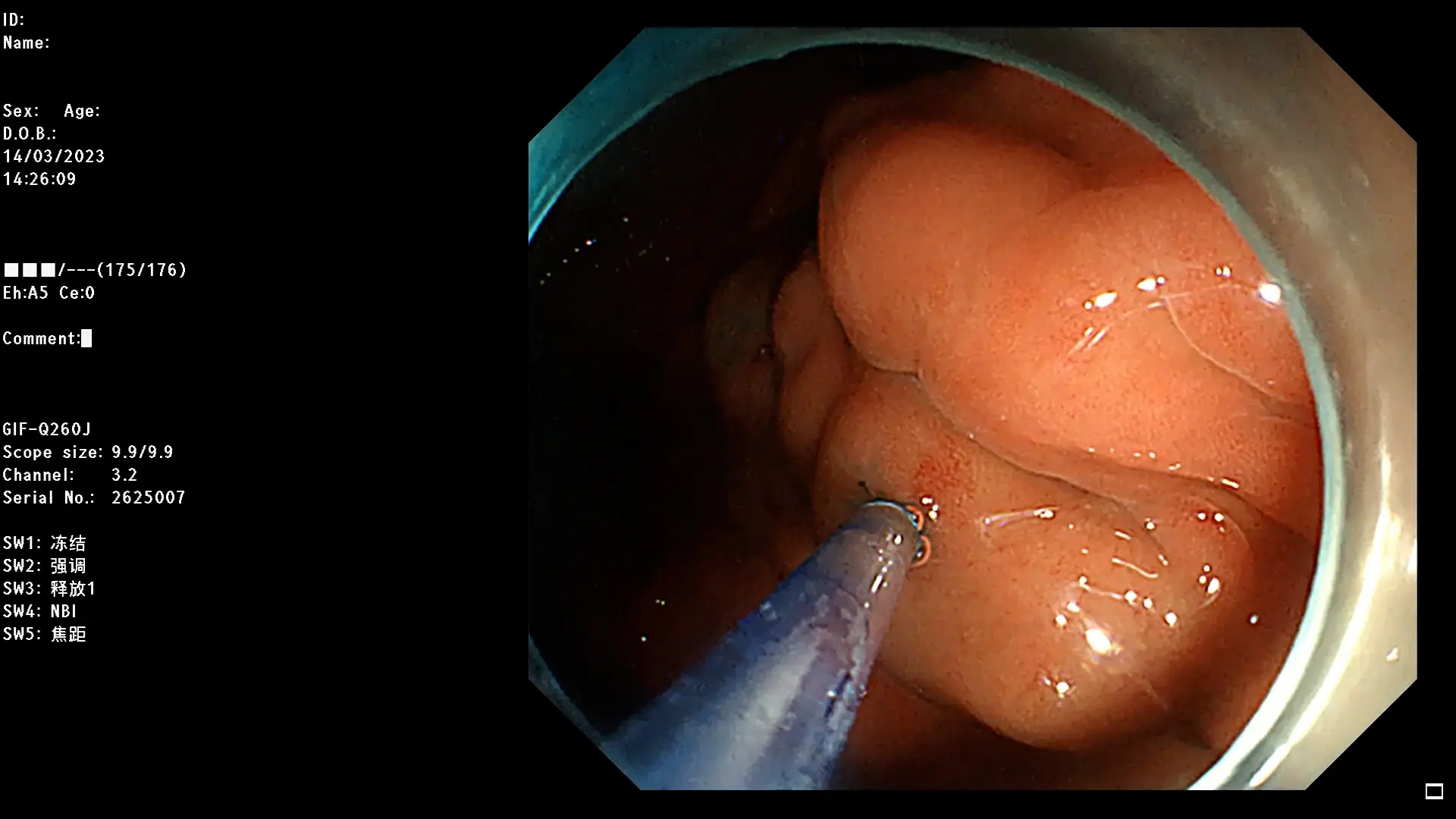 Endoscopic Injection Sclerotherapy Assisted by Cyanoacrylate and Clips for Gastroesophageal Varices