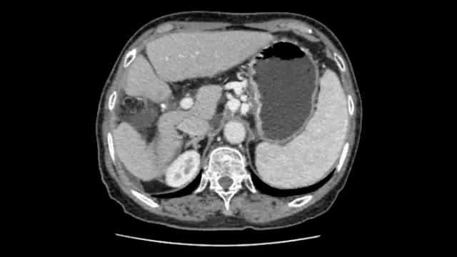 Laparoscopic Anatomical Resection of the Right Anterior Lobe Based on the Laennec Capsule Technique