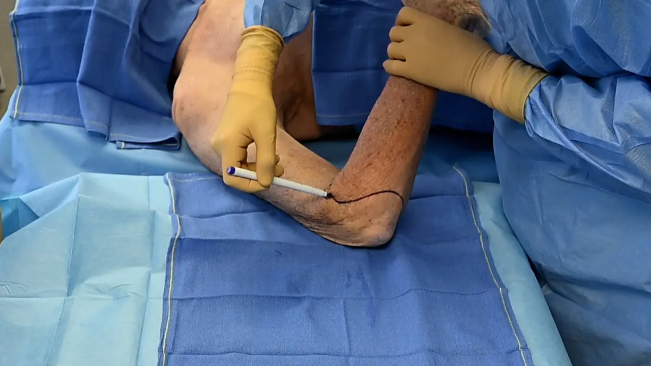 Vascularized Composite Hand Allograft Procurement and Preparation for Distal and Proximal Forearm Allotransplantation: A Stepwise Approach