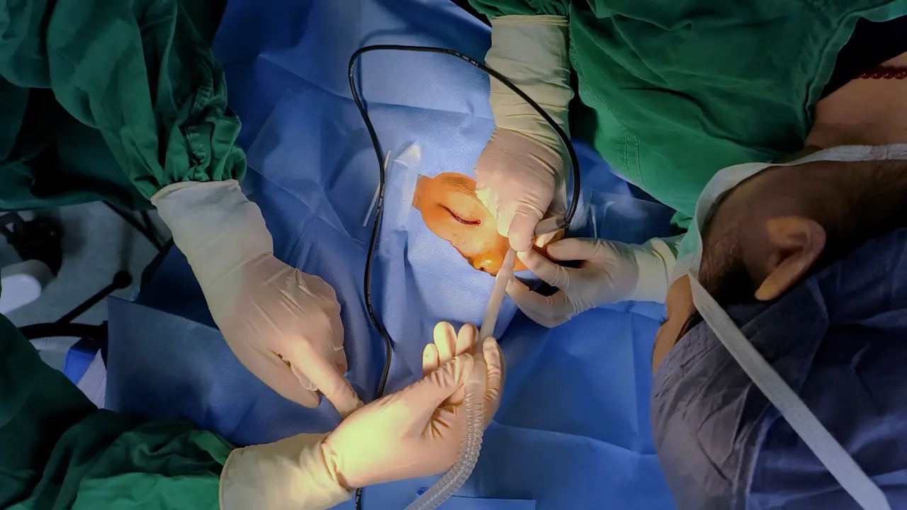 Surgical Correction for Pediatric Epiblepharon and Trichiasis