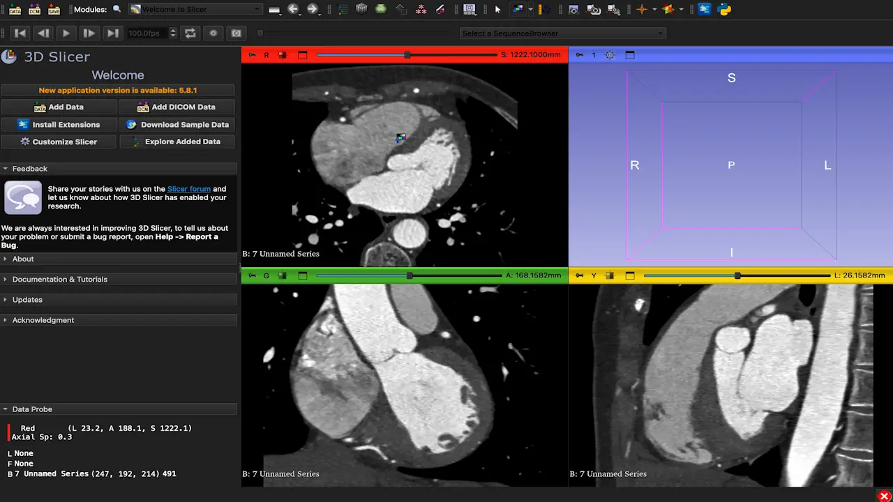 Mixed Reality Technology and Three-Dimensional Printing in Teaching: Heart Anatomy as an Example