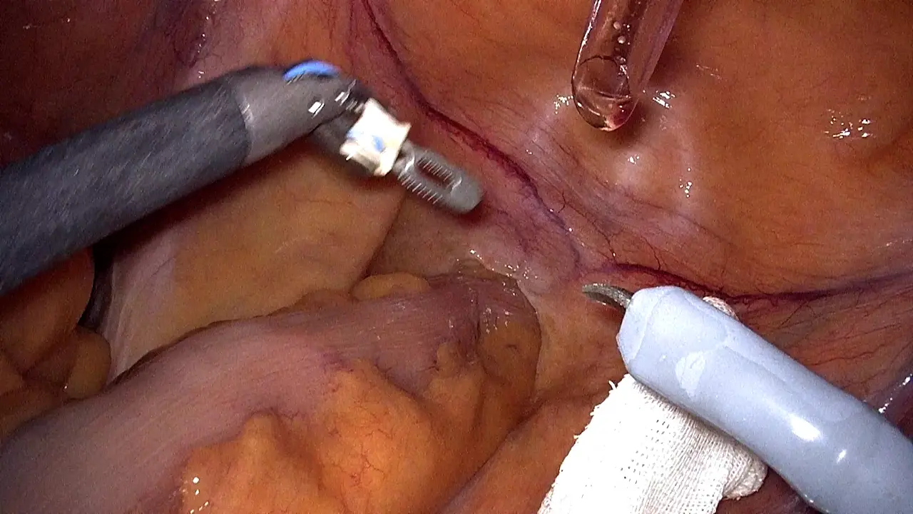 Surgical Robot-Assisted Transanal Specimen Extraction Radical Sigmoidectomy Without an Auxiliary Abdominal Incision