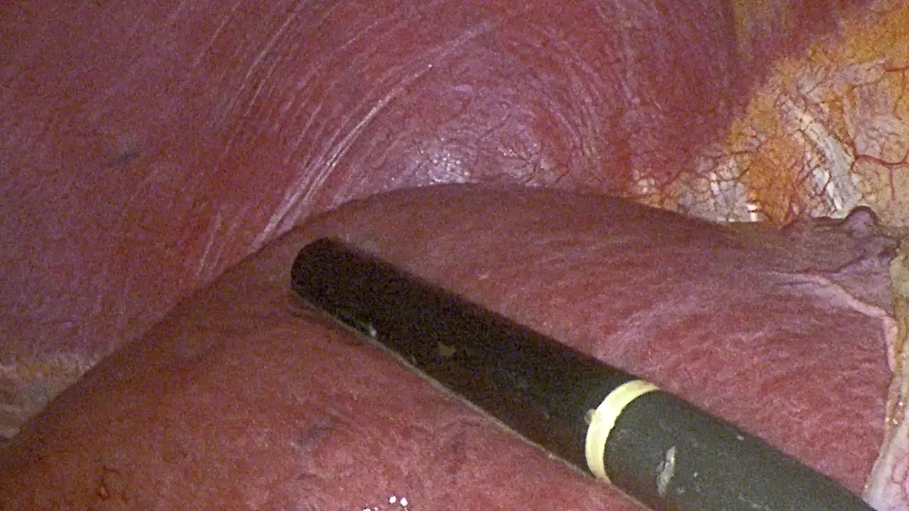 Laparoscopic Anatomical Hepatectomy Using Takasaki's Approach and Indocyanine Green Fluorescence Navigation