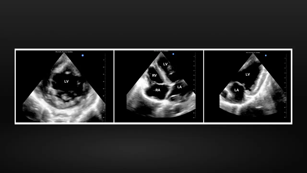 A High-Fidelity Porcine Model of Orthotopic Heart Transplantation Following Donation after Circulatory Death
