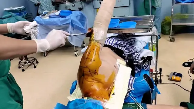 Arthroscopic Management of Massive Irreparable Rotator Cuff Tears: Whole Rotator Cable Reconstruction Using Proximal Biceps Tendon Autograft