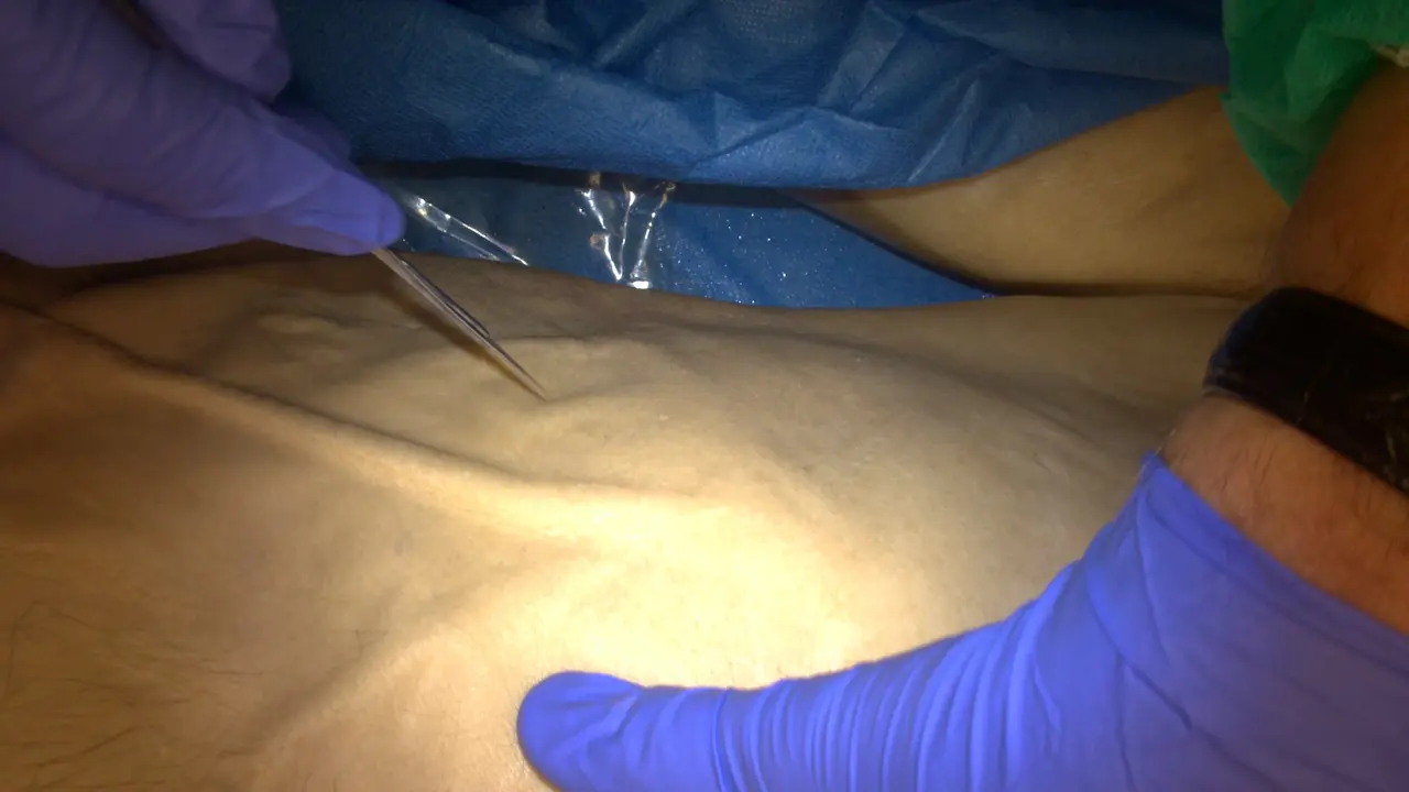 The Role of Anatomical Dissection in Defining Colic and Small Bowel Artery Lymphovascular Bundles in the D3 Volume of Small and Large Bowel Mesentery
