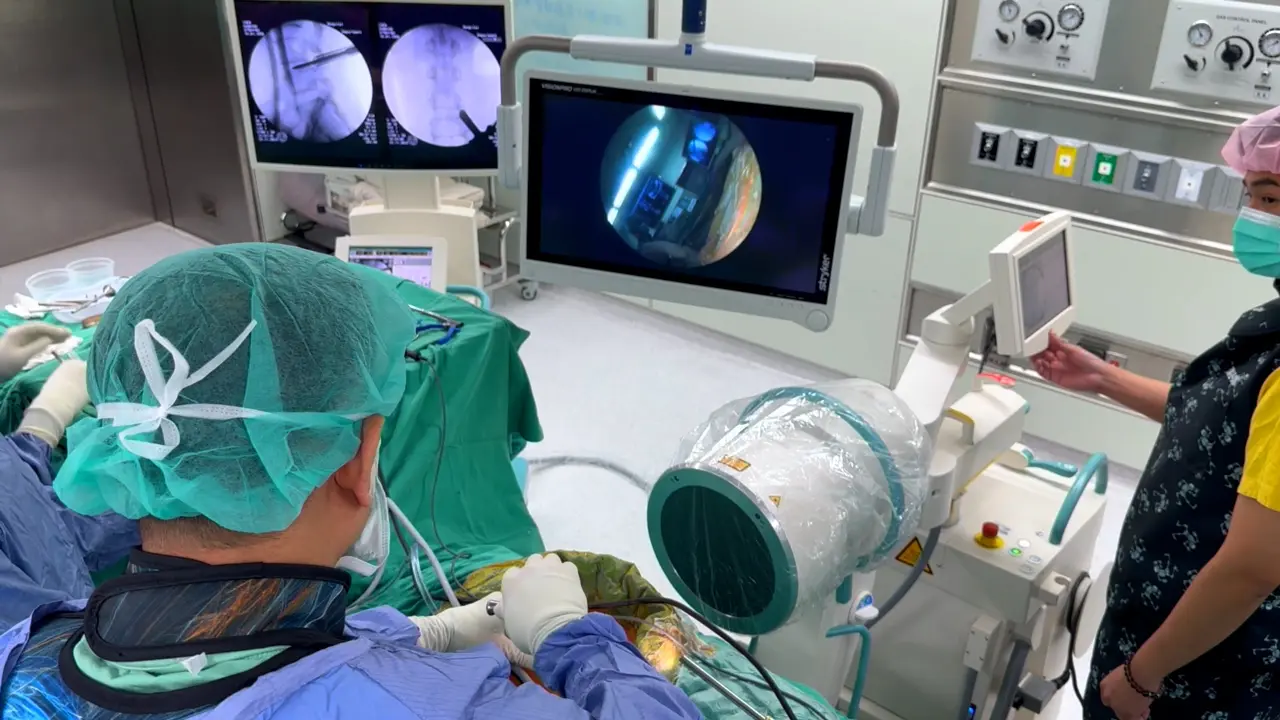 Uniportal Full Endoscopic Posterolateral Transforaminal Lumbar Interbody Fusion
