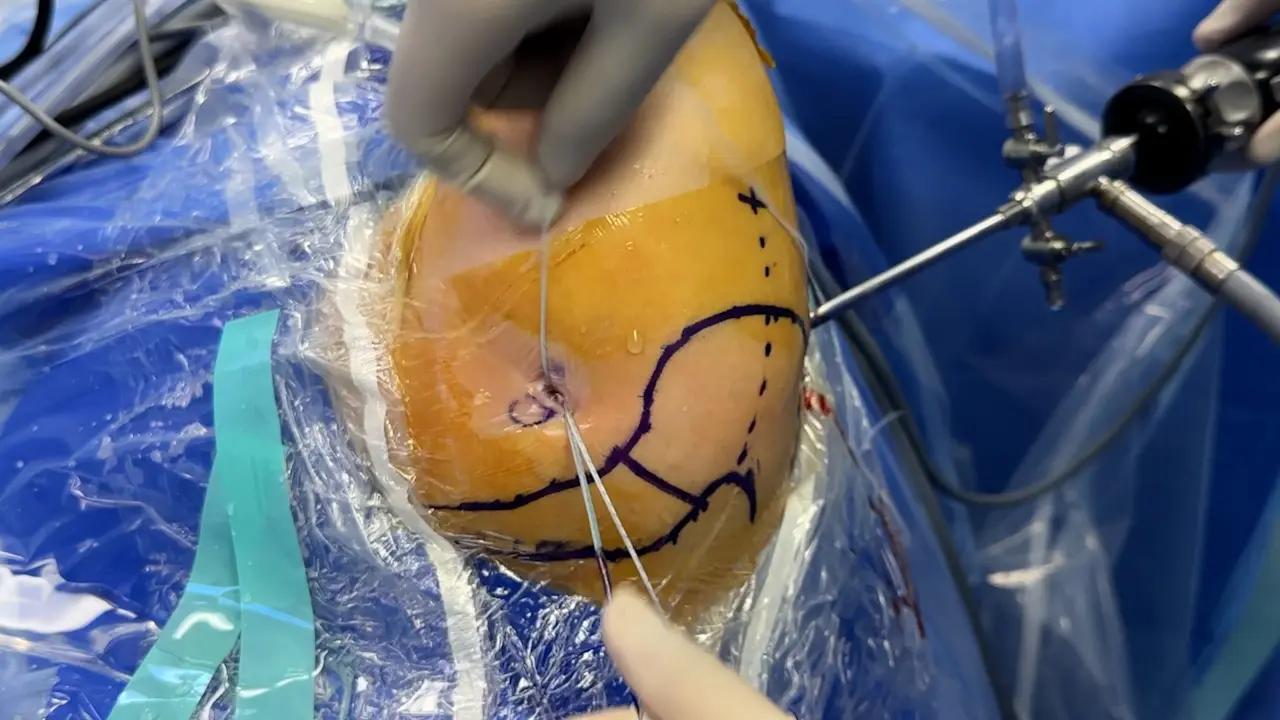 The Modified Single-working Portal Technique Using Lasso-loop Stitch with Needle for Arthroscopic Subscapularis Repair