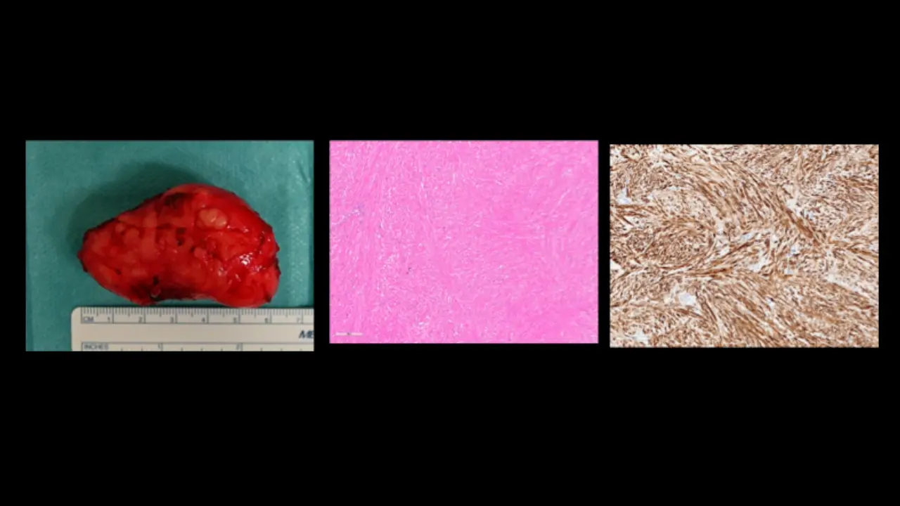 Robotic Enucleation of Esophageal Leiomyoma