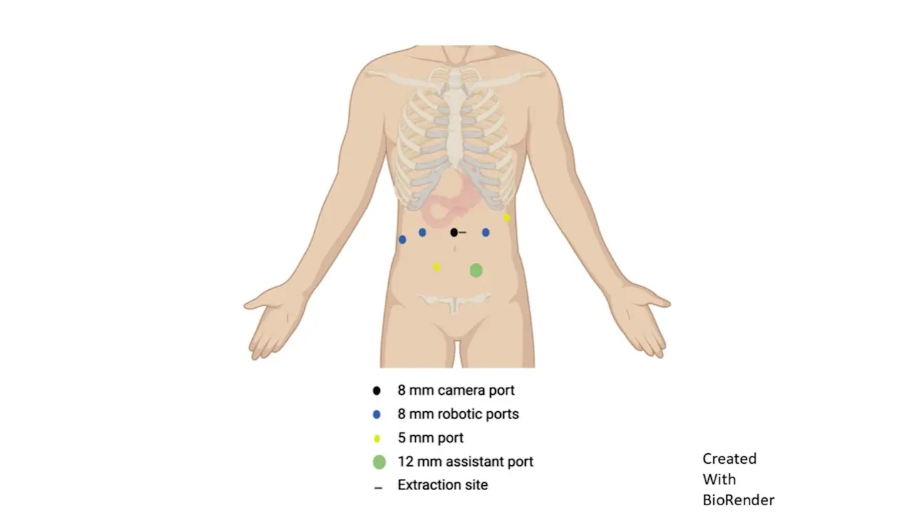 Robotic Duodenal Sleeve Resection for Gastrointestinal Stromal Tumor with Rare Exon 8 KIT Mutation Following Neoadjuvant Imatinib