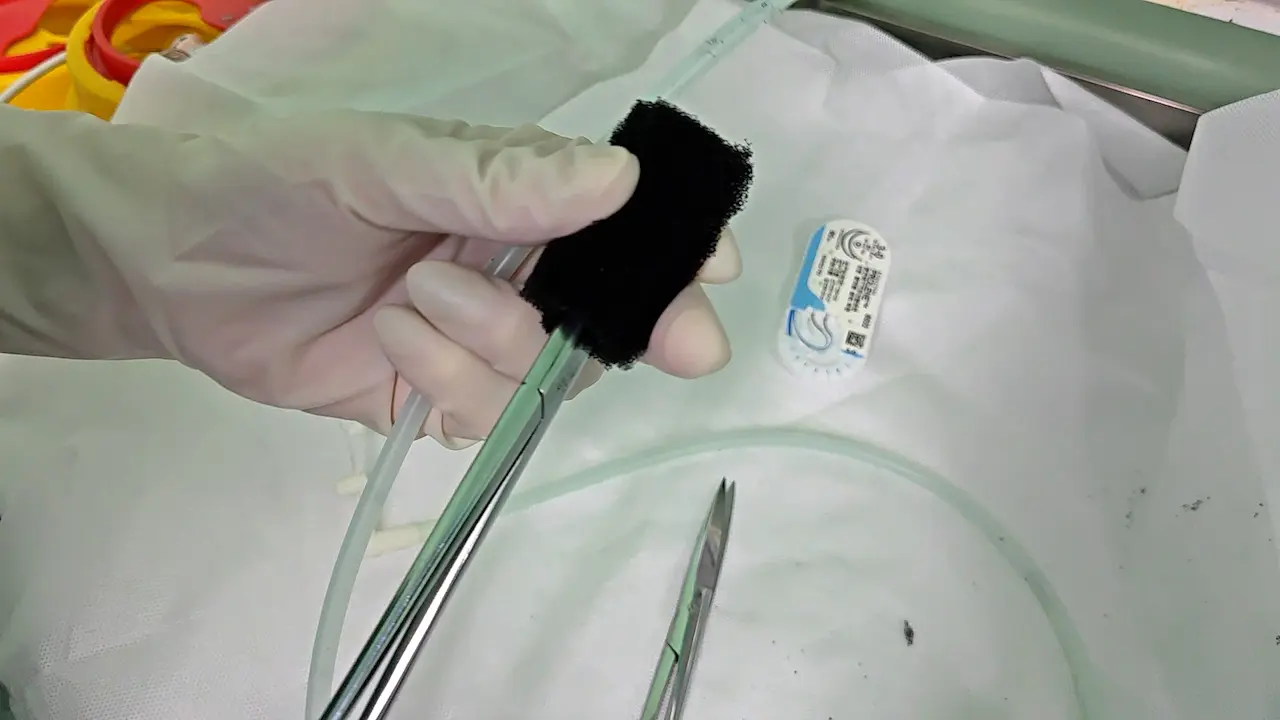 Endoscopic Vacuum Therapy for the Treatment of Anastomotic Leakage after Total Gastrectomy with Esophagojejunostomy