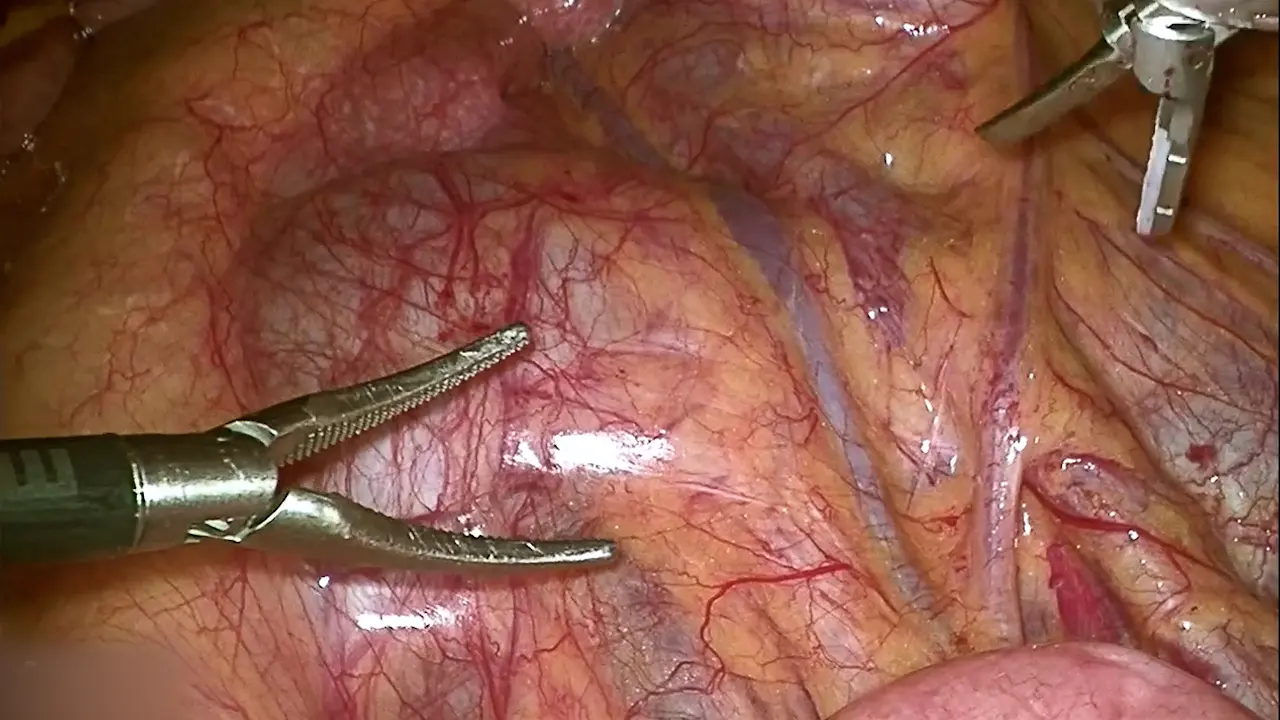 Transmesenteric Laparoscopic Pyeloplasty in Trendelenburg Position for Horseshoe Kidney with Hydronephrosis