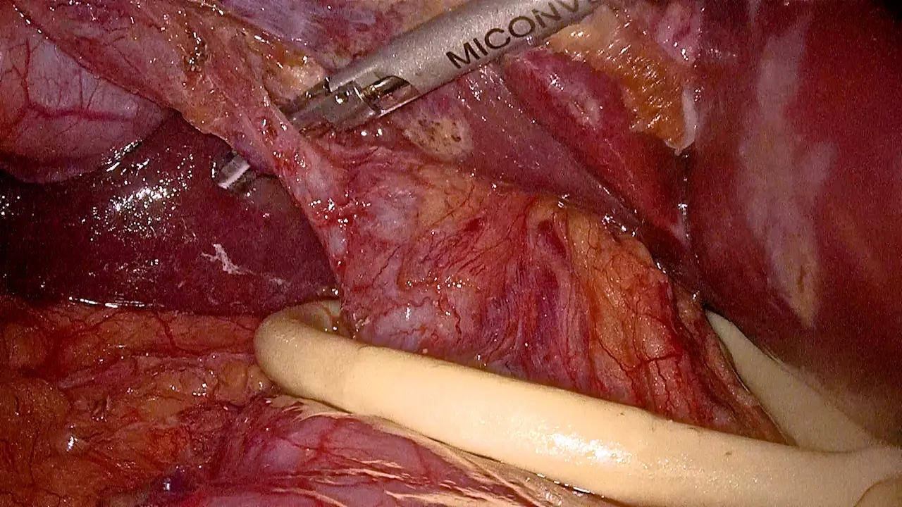 Laparoscopic Anatomical Right Hemihepatectomy via the <em>In Situ</em> Anterior Approach