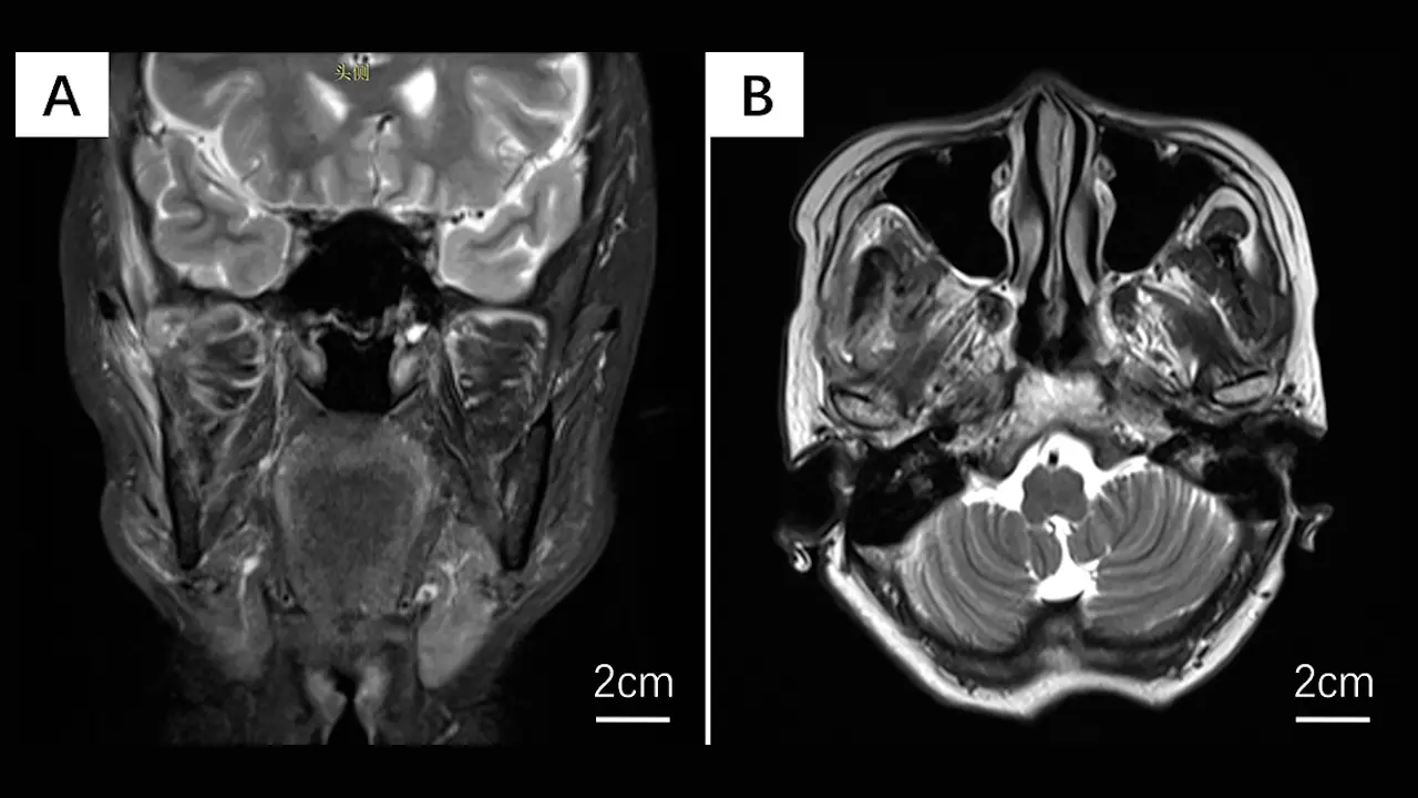 Lateral Molar Approach-Driven Transoral Endoscopic Procedure for Benign Infratemporal Fossa Tumor Resection