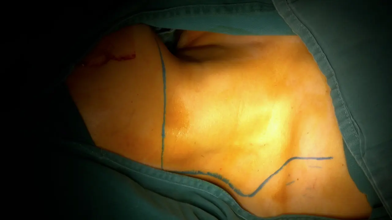 Modified Radical Neck Dissection for Cervical Metastasis