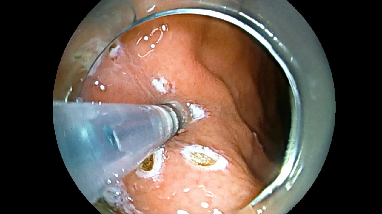 Evaluation of the Effectiveness of Longitudinal Incision for Endoscopic Submucosal Excavation of Gastric Subepithelial Lesions