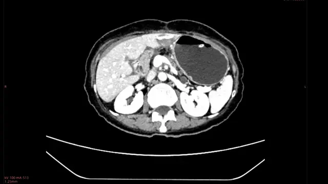 Application of Simplified Stent-bridging Pancreaticogastrostomy in Open Pancreaticoduodenectomy