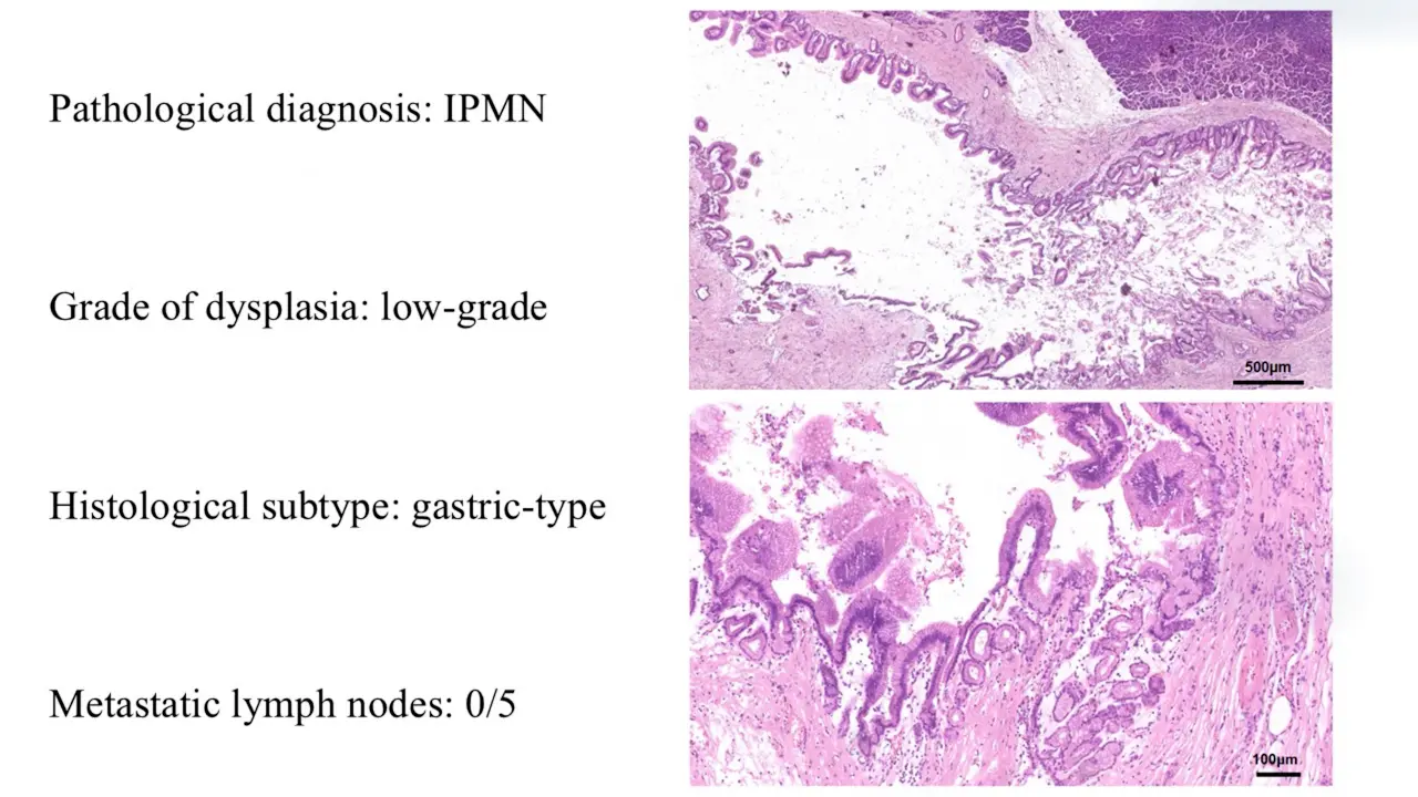 Robotic Duodenum-preserving Total Pancreatic Head Resection for Intraductal Papillary Mucinous Neoplasms