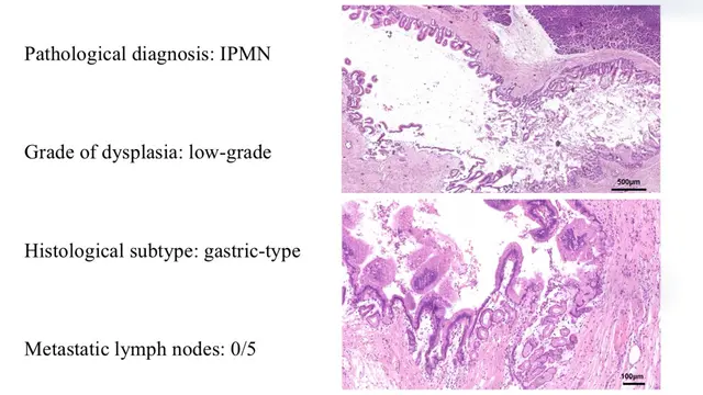 Robotic Duodenum-preserving Total Pancreatic Head Resection for Intraductal Papillary Mucinous Neoplasms