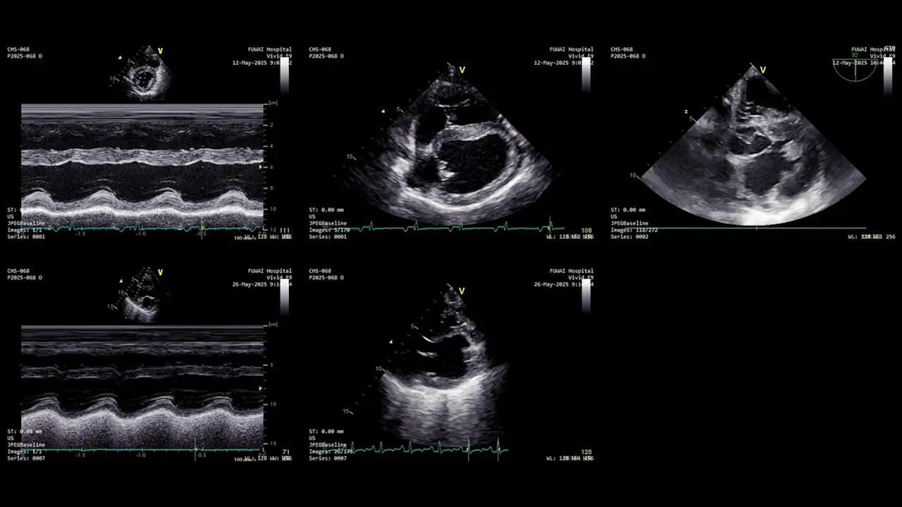 Implantation of Left Ventricular Assist Device (LVAD) in Juvenile Landrace Swine: A LVAD Implantation Model of Pediatric Heart Failure