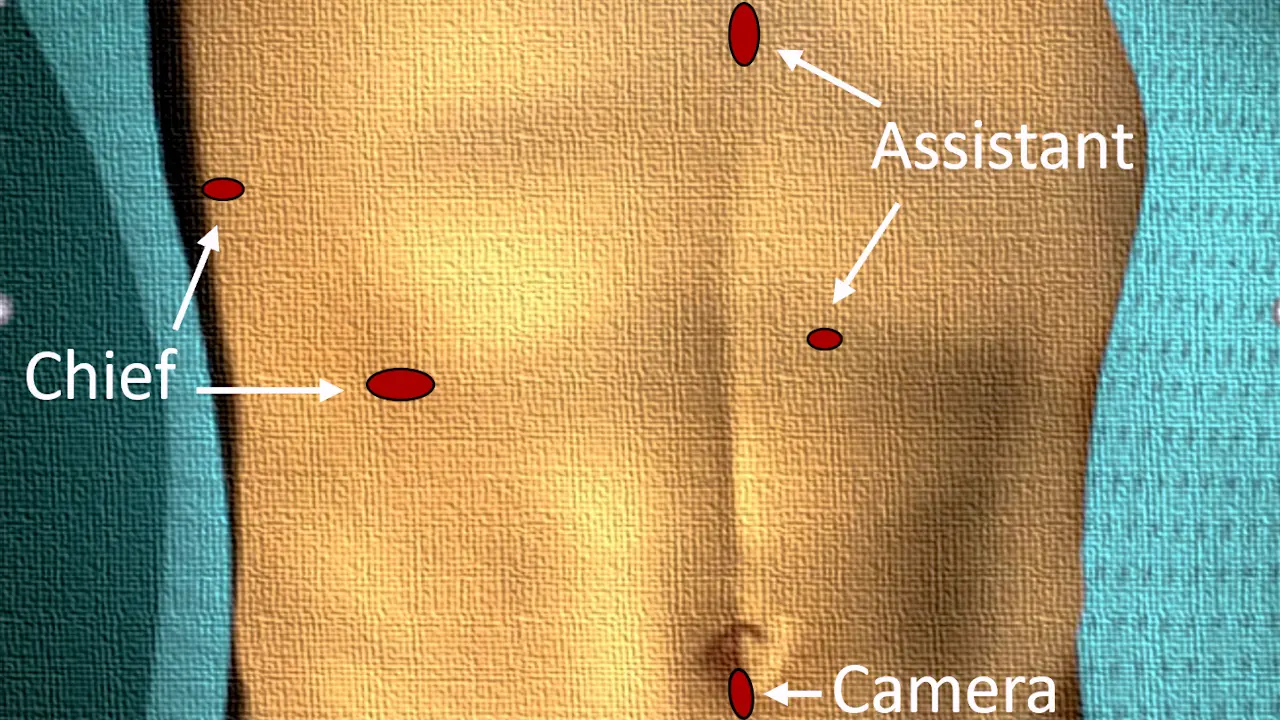 Laparoscopic Anatomical Right Anterior Sectionectomy with a Hepatic Pedicle-first Approach: Technical Details and Representative Case Illustration