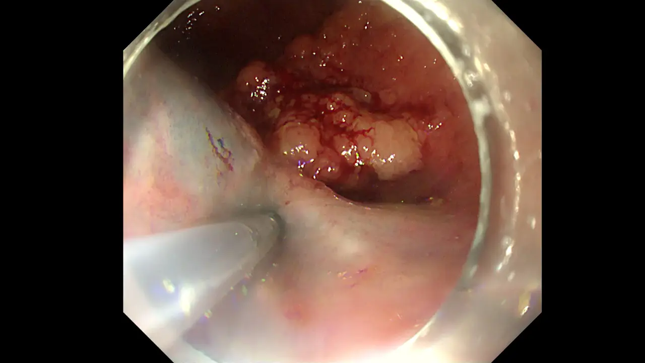 The Pocket-Creation Procedure of Endoscopic Submucosal Dissection for Large Rectal Laterally Spreading Tumors