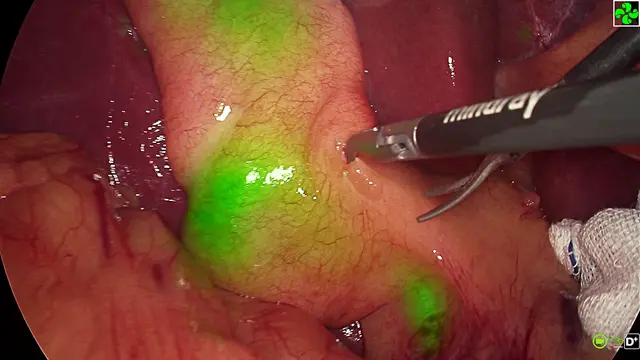 Laparoscopic Cholecystectomy with Indocyanine Green Fluorescence: Choledochoscopic Stone Extraction and Primary Duct Suture