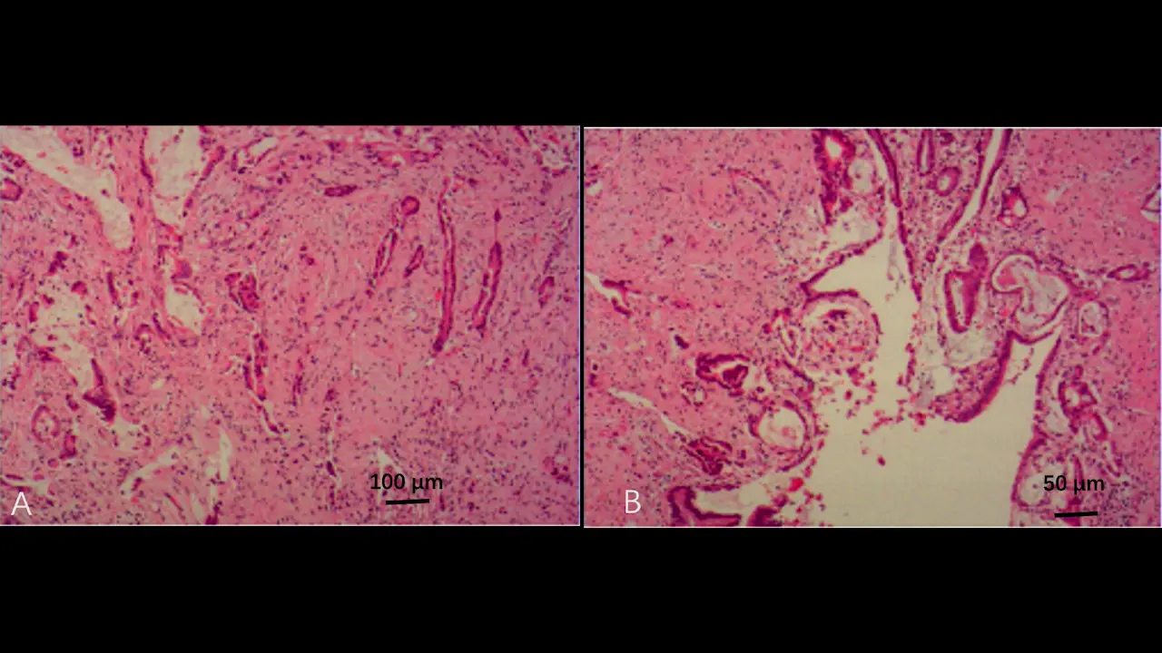 Intraoperative Strategy under Complex Vascular Adhesion for Laparoscopic Radical Resection of Bismuth-Corlette Type IIIb Perihilar Cholangiocarcinoma