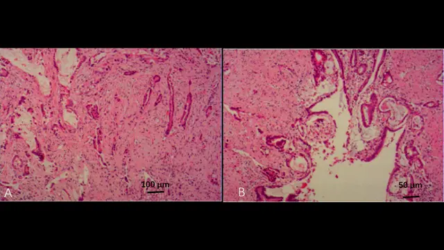 Intraoperative Strategy under Complex Vascular Adhesion for Laparoscopic Radical Resection of Bismuth-Corlette Type IIIb Perihilar Cholangiocarcinoma
