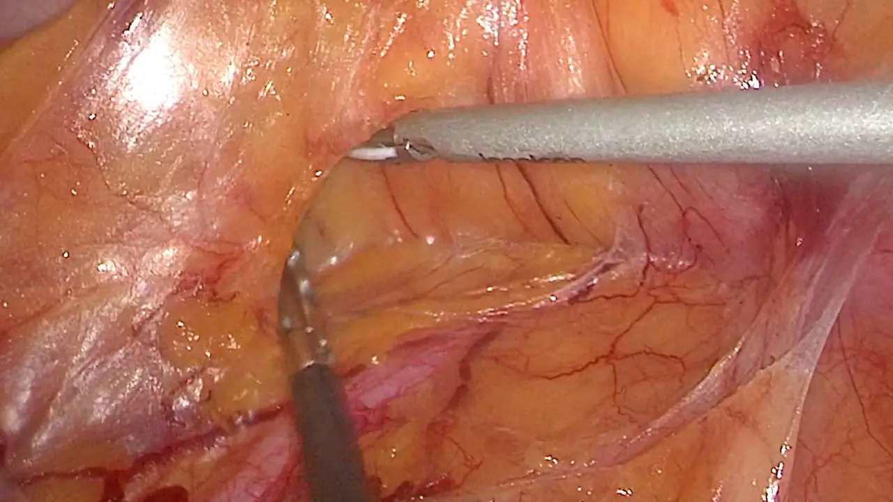 Caudal-to-cranial Approach in Laparoscopic Right Hemicolectomy with Complete Mesocolon Excision and D3 Lymph Node Dissection