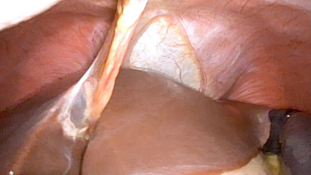 Robot-Assisted Laparoscopic Splenectomy In Children: A Case Report with Literature Review