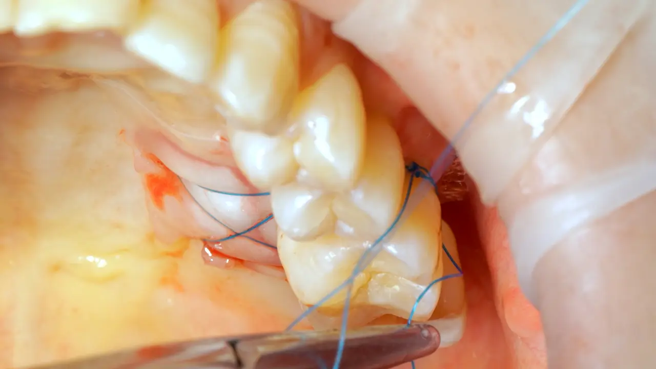 A Simplified Protocol for Protecting Palatal Soft Tissue Donor Sites Using an Oral Mucoadhesive Bandage