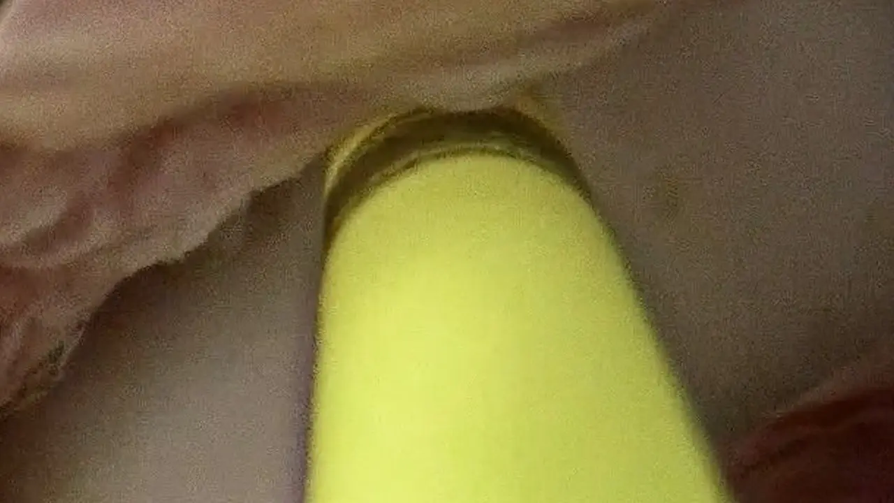 Removal of an Intravesical Gellhorn Pessary and Staged Repair of a Residual Large Vesico-Vaginal Fistula