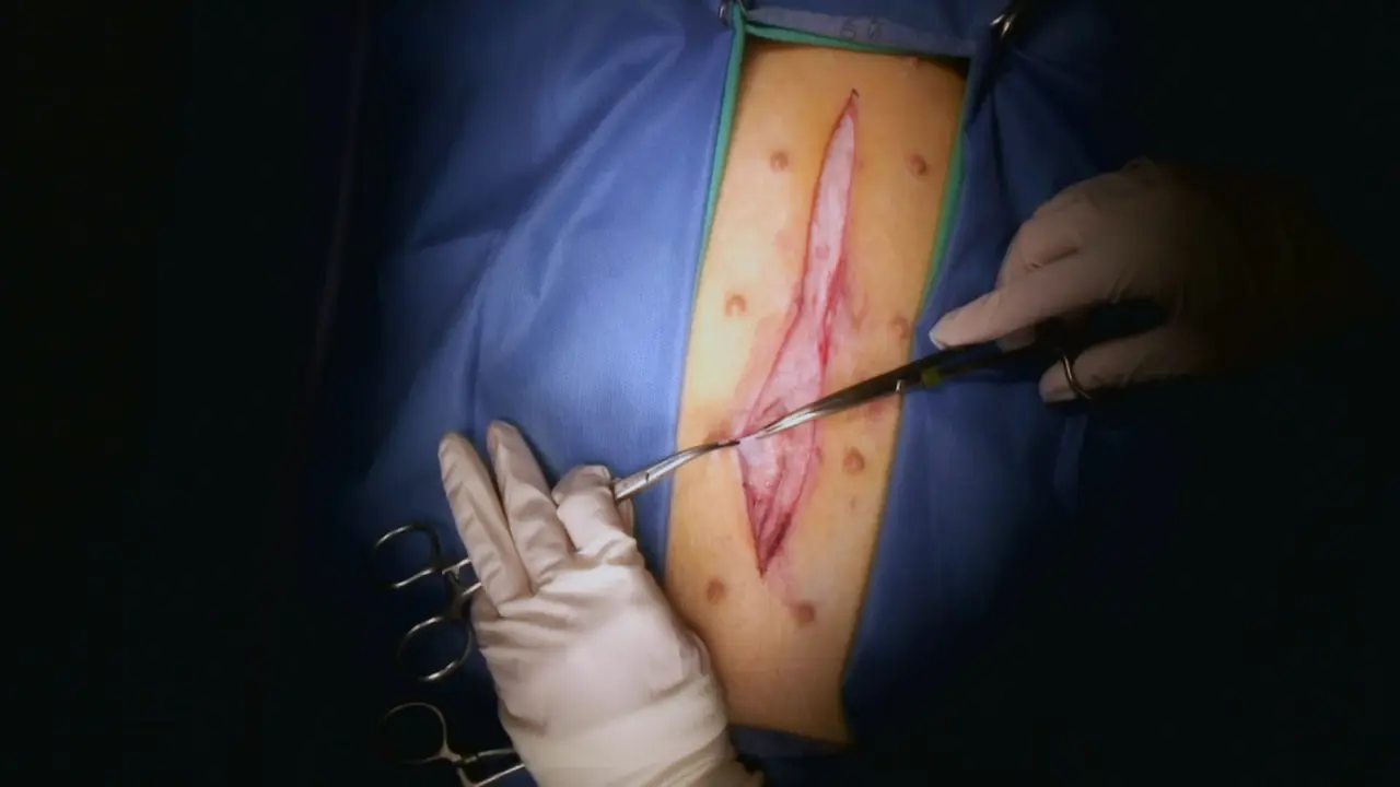 A Translational Surgical Porcine Model for Postoperative Intra-Abdominal Adhesion Formation