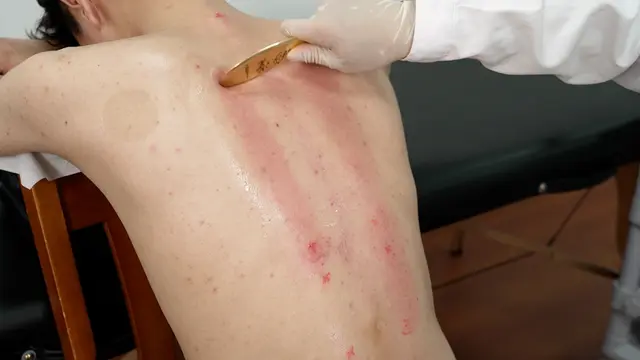 A Standardized Copper Bian-Stone Gua Sha Protocol for Treating Chronic Fatigue Syndrome in Human Subjects