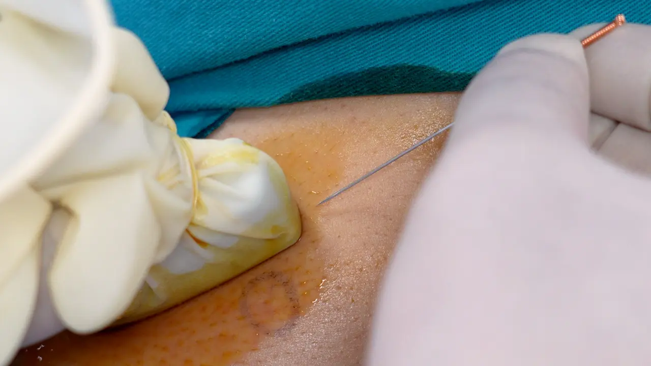 Ultrasound-Guided Acupotomy Release With Biomechanical Assessment For Trapezius Myofascial Pain Syndrome