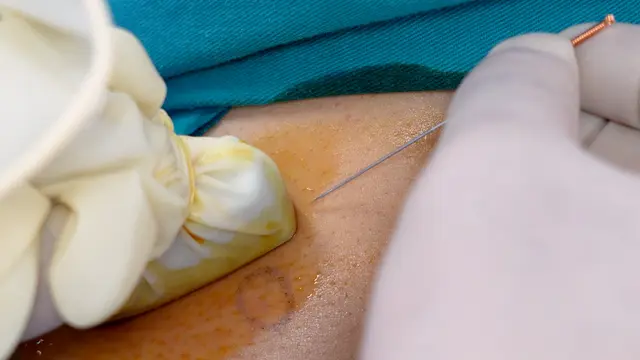 Ultrasound-Guided Acupotomy Release With Biomechanical Assessment For Trapezius Myofascial Pain Syndrome