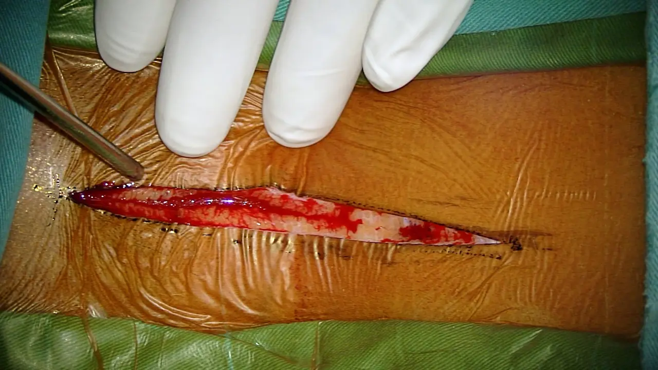 Expansion Duroplasty For Severe Cervical Spinal Cord Swelling After Traumatic Injury: A Step-by-Step Surgical Protocol