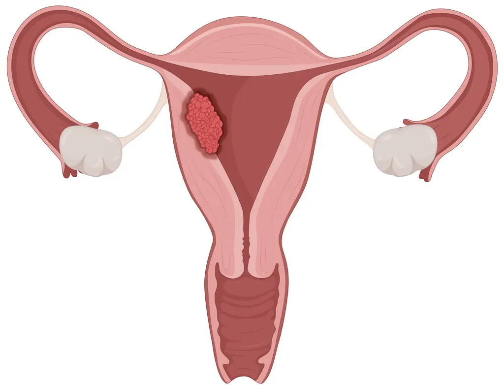 Gynecologic Cancer