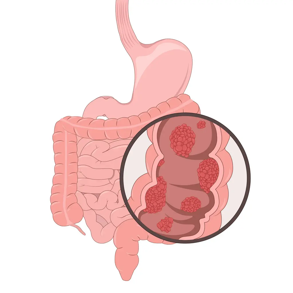 Colorectal Cancer
